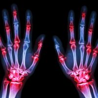 X-ray showing both human's hands and arthritis at multiple joints